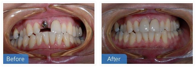 Implants Dental Implants 01 - Implants