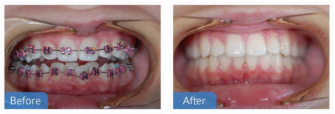 Orthodontic dental 01 - Cosmetic Dentistry