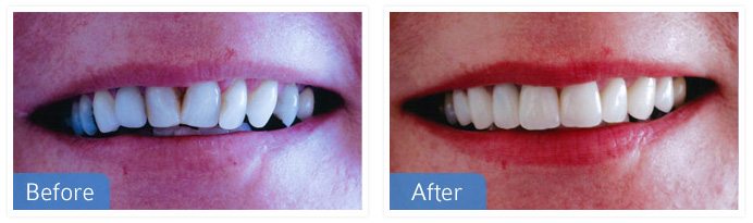 cosmetic dentistry 01 - Veneers & Crowns