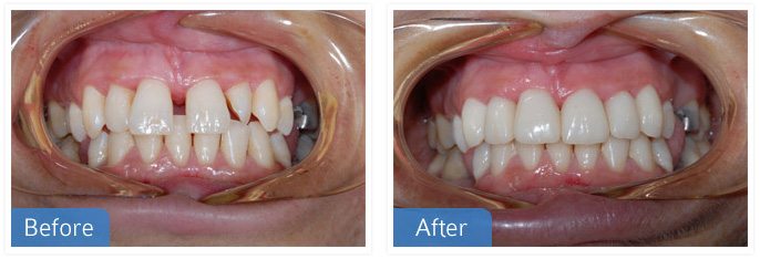 crowns veneers 01 - Cosmetic Dentistry