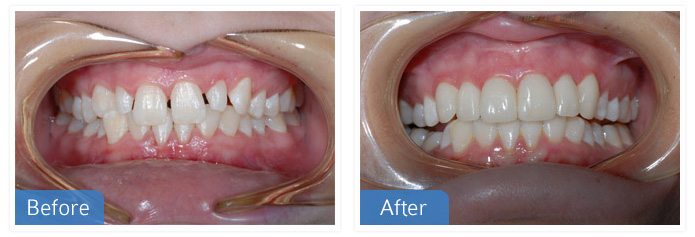 general dentistery before after - General Dentistry